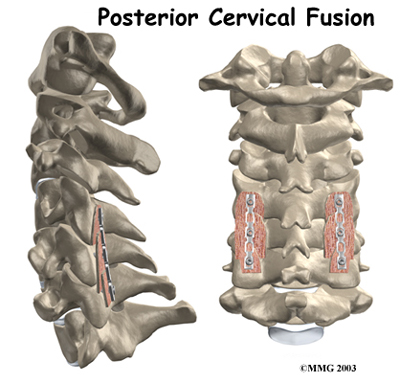Posterior Cervical Fusion